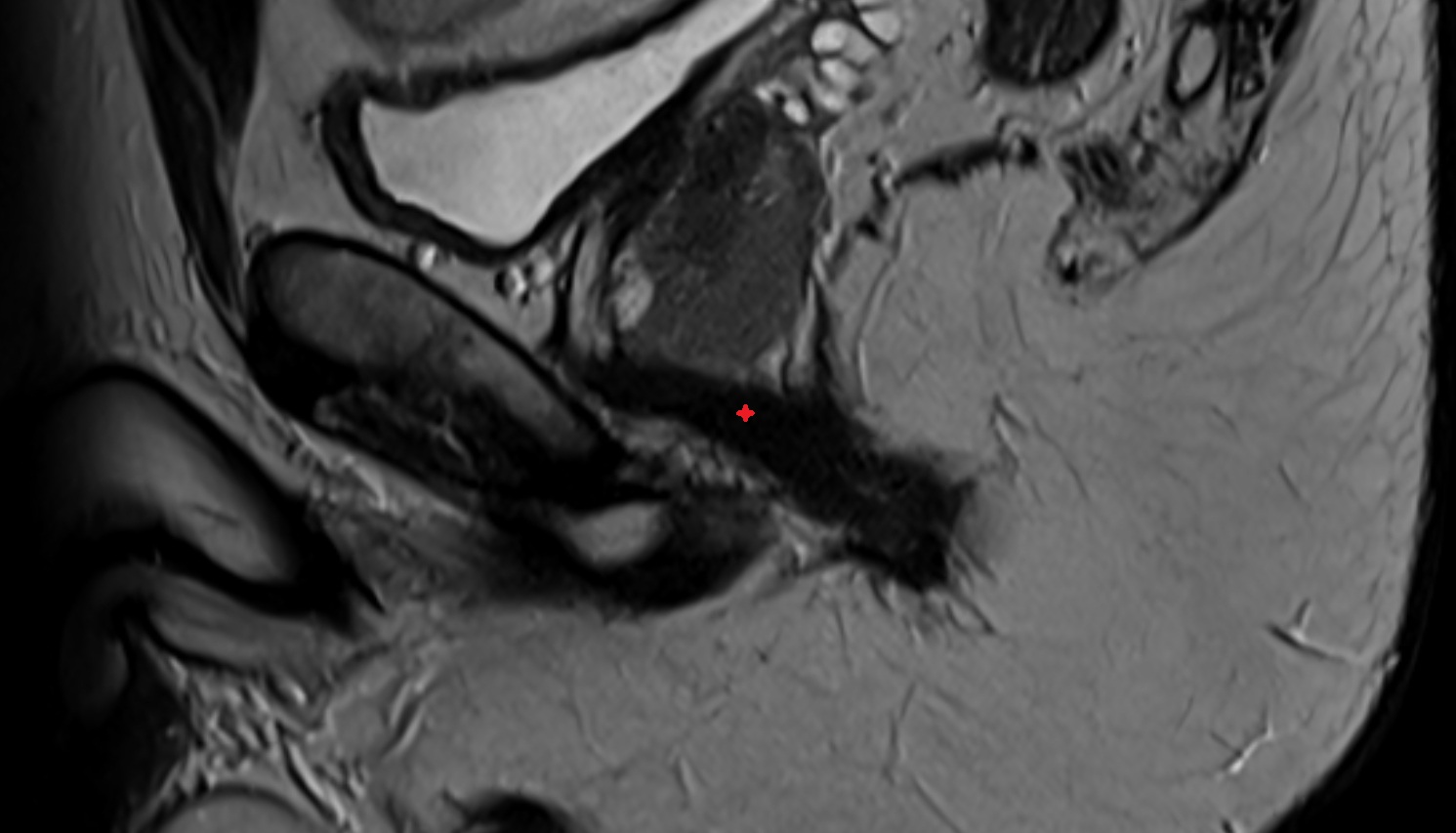 Puborectalis muscle MRI sag  anatomy  image-img-00000-00000