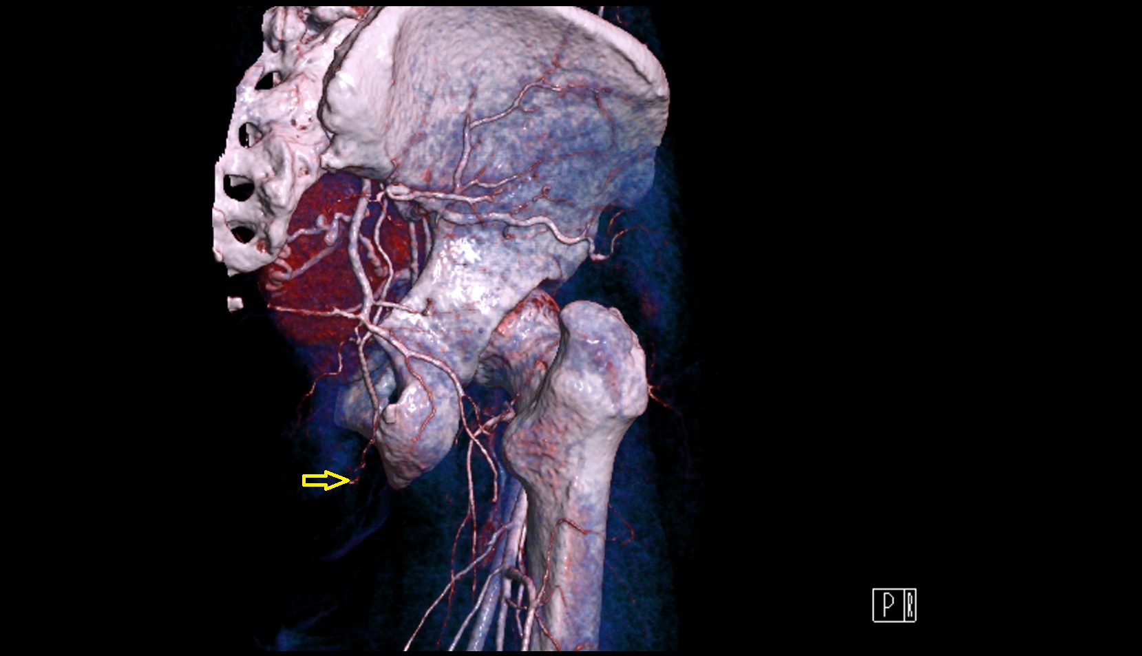 Pudendal artery  CT 3D VRT anatomy image