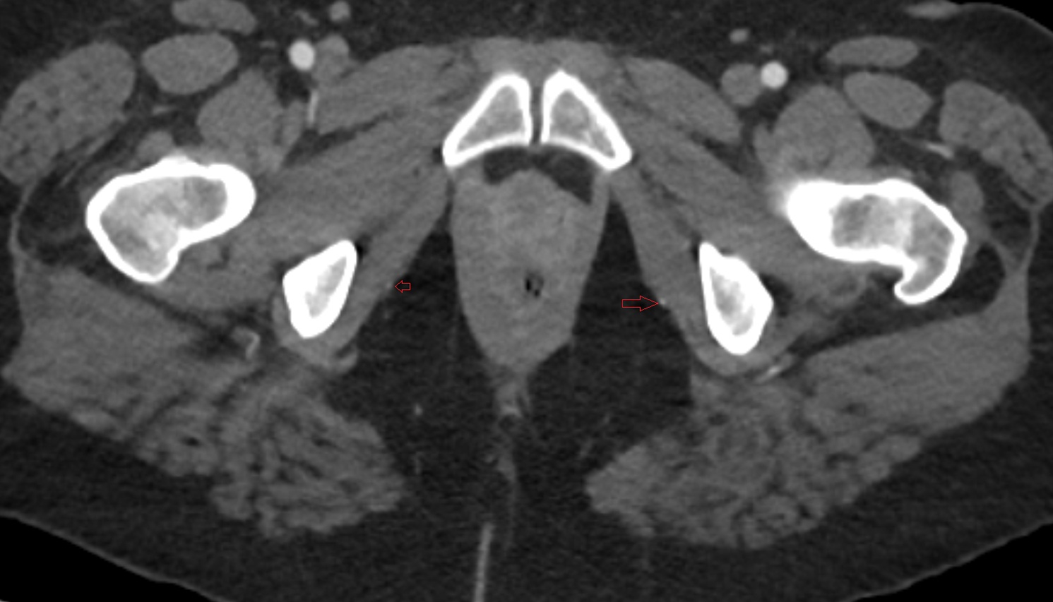 Pudendal artery  CT  axial  anatomy  image-img-00000-00000