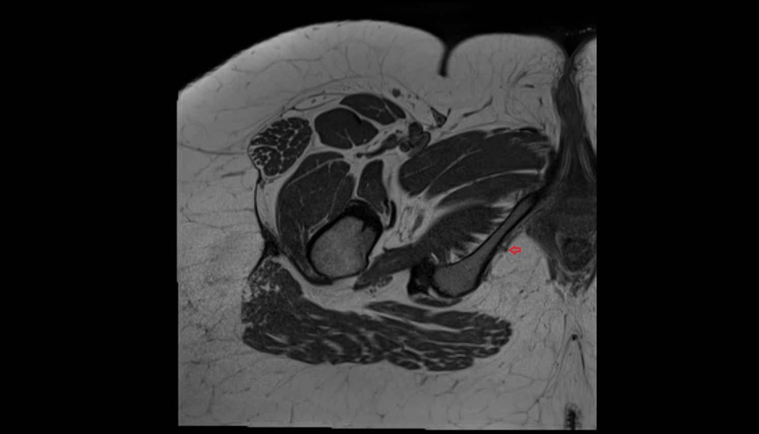 Pudendal artery  MRI axial image  MRI  axial  anatomy  image-img-00000-00000