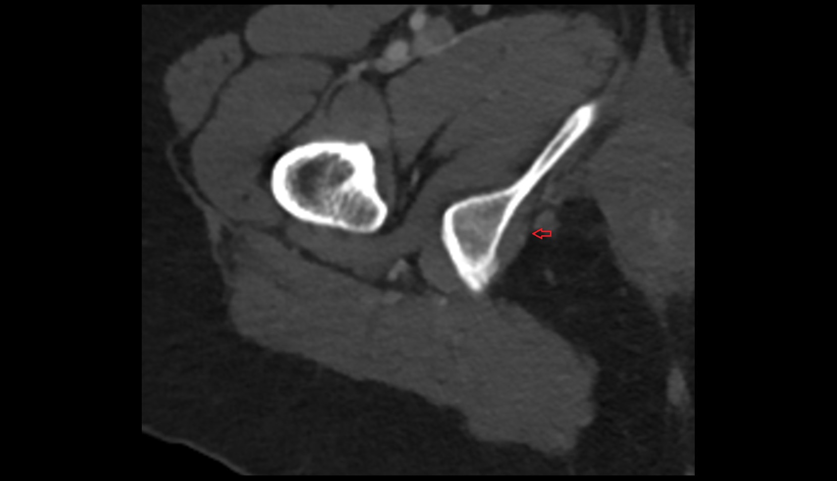 Pudendal nerve CT axial image 0