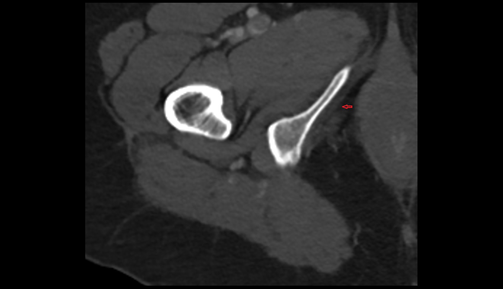 Pudendal nerve CT axial image 1