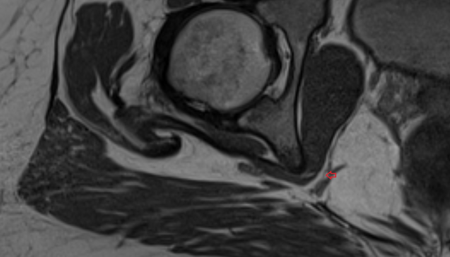 Pudendal nerve  MRI  axial  anatomy  image-0