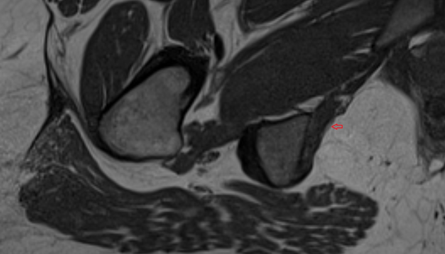 Pudendal nerve  MRI  axial  anatomy  image-img-00000-00000