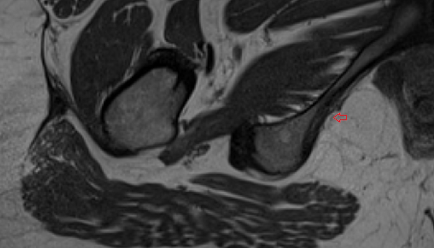 Pudendal nerve  MRI  axial  anatomy  image-img-00000-00000_00002