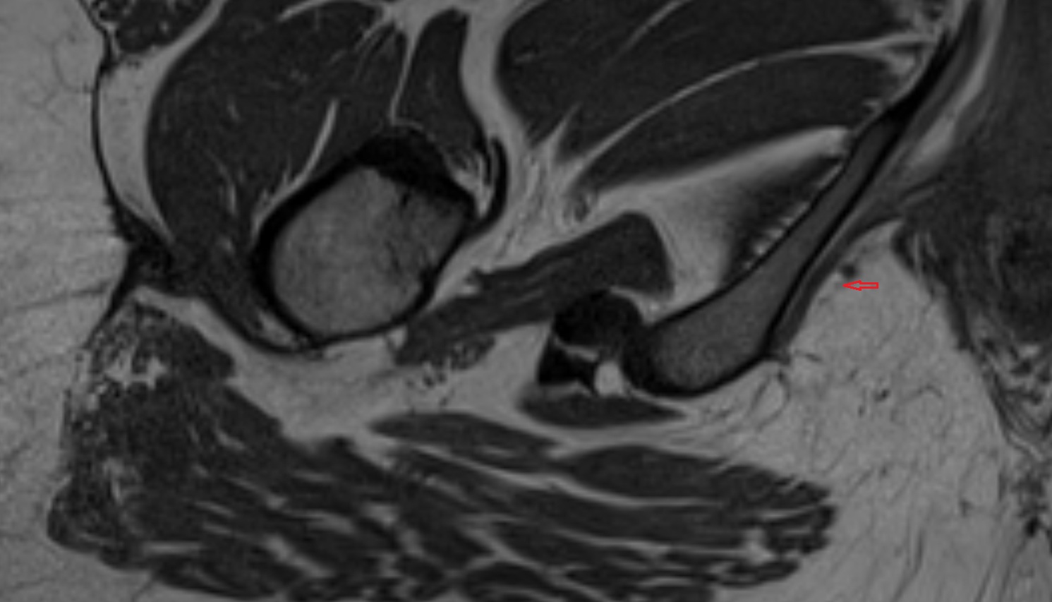 Pudendal nerve  MRI  axial  anatomy  image-img-00000-00000_00003