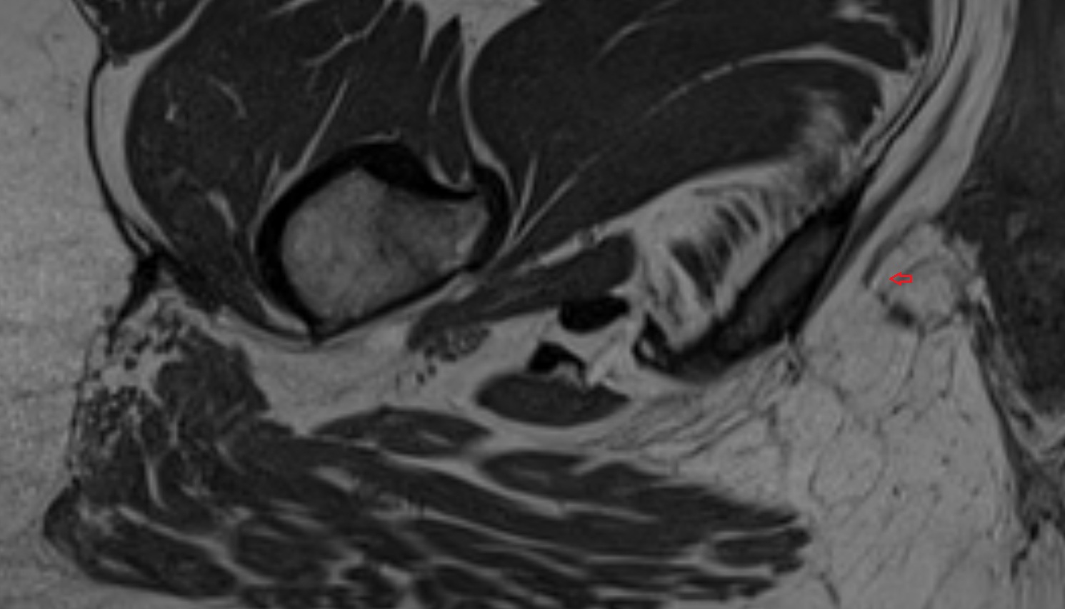 Pudendal nerve  MRI  axial  anatomy  image-img-00000-00000_00004