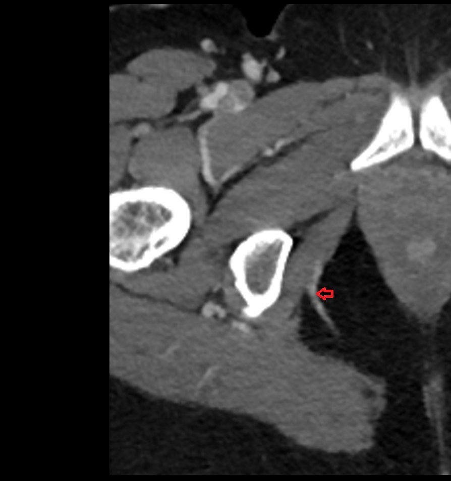 Pudendal vein CT axial image