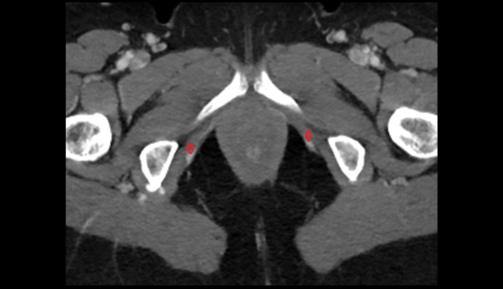 Pudendal vein CT axial image 1