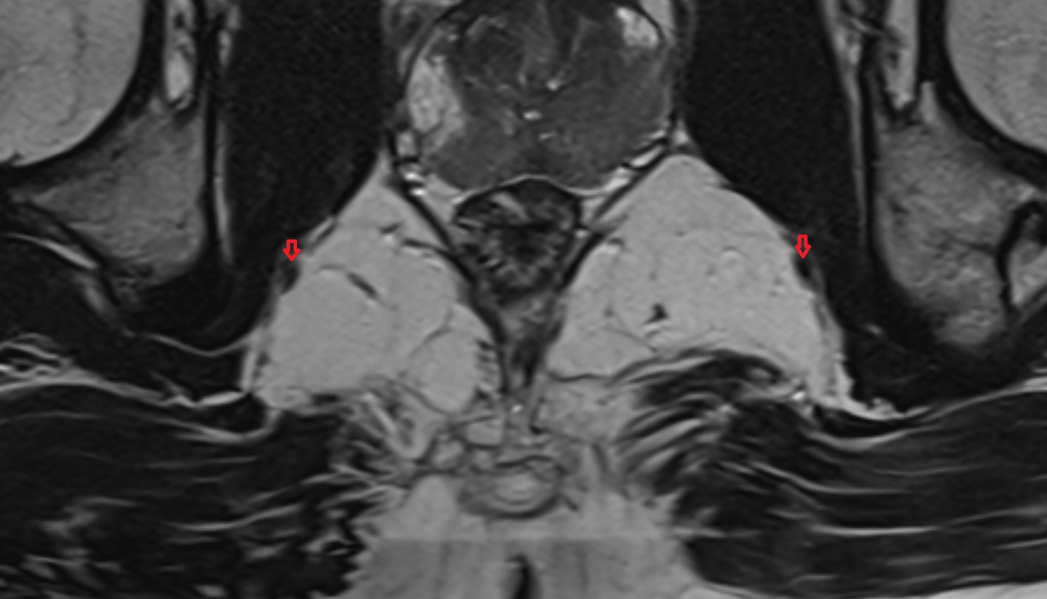 Pudendal vein   MRI  axial  anatomy  image-img-00000-00000