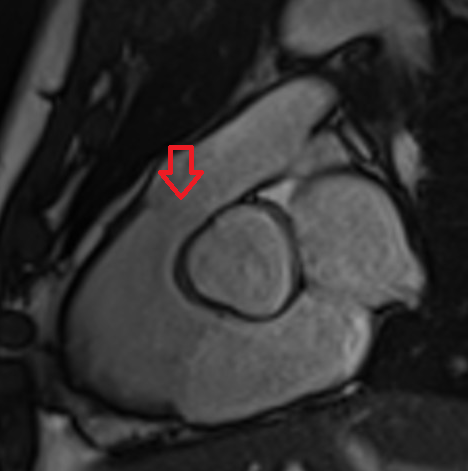 Pulmonary Valve anatomy MRI image