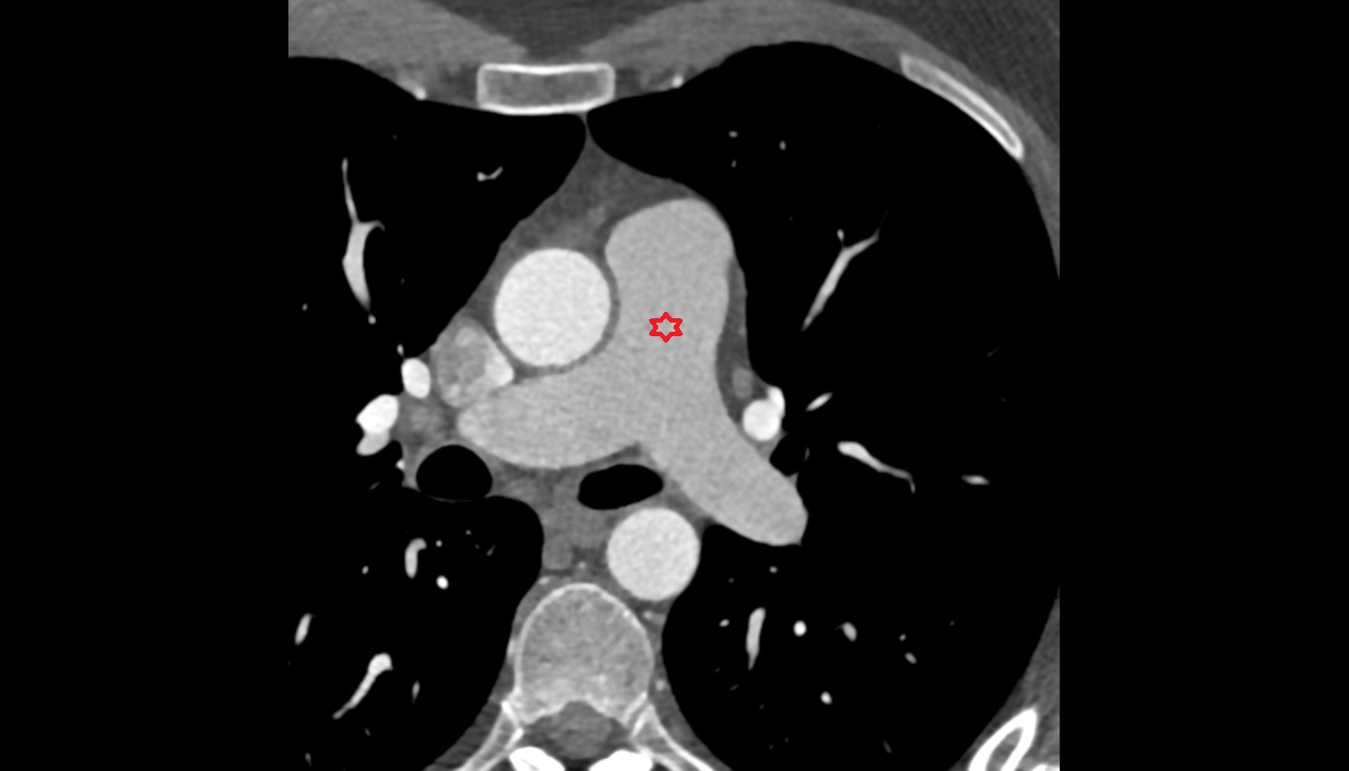 Pulmonary trunk anatomy  CT axial image -img-00000-00000