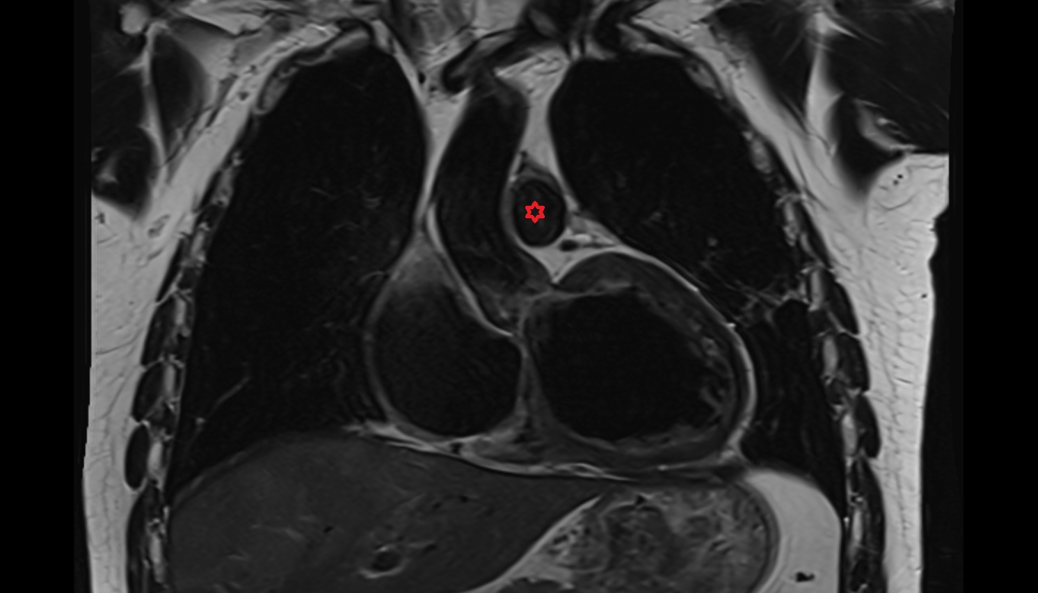 Pulmonary trunk anatomy  mri coronal image -img-00000-00000