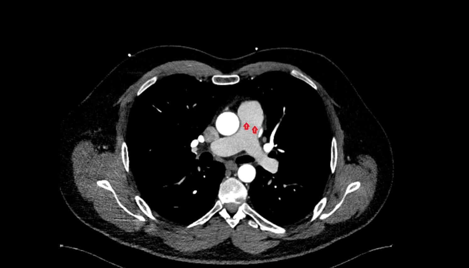 Pulmonary valve anatomy  MRI axial  image -img-00000-00000