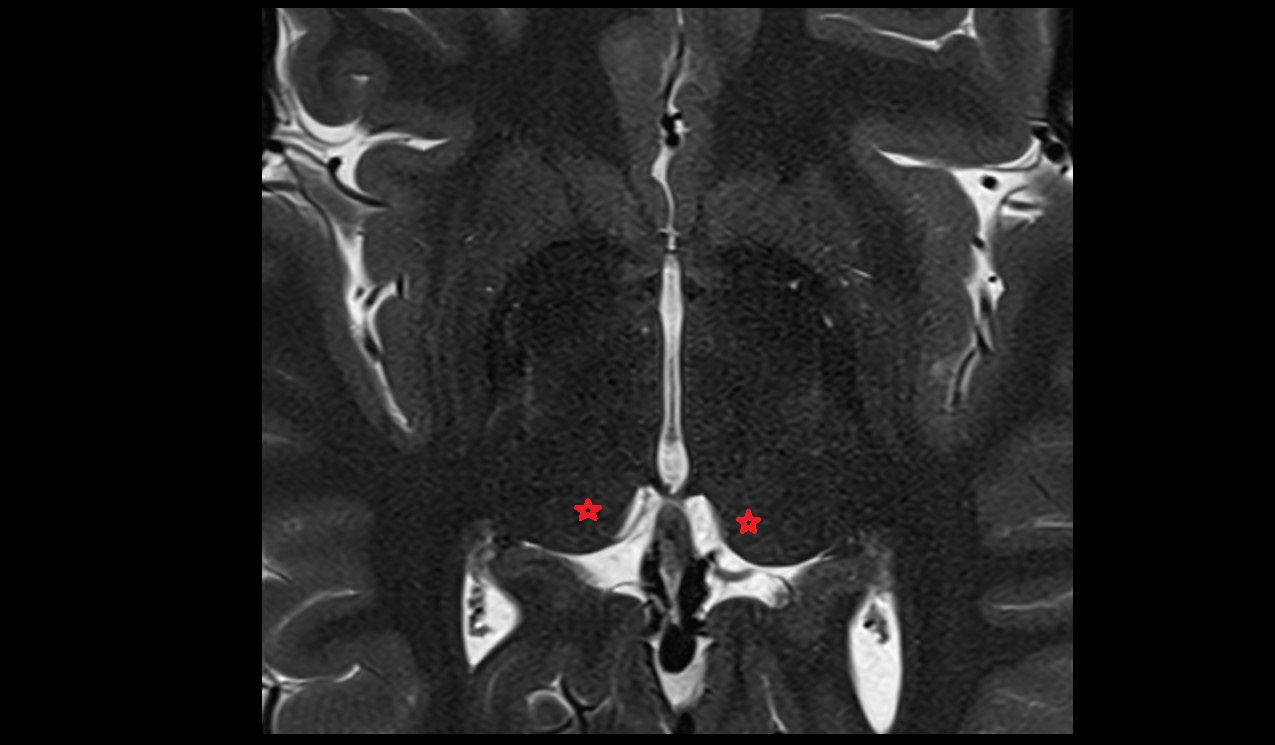 Pulvinar mri 3t axial image