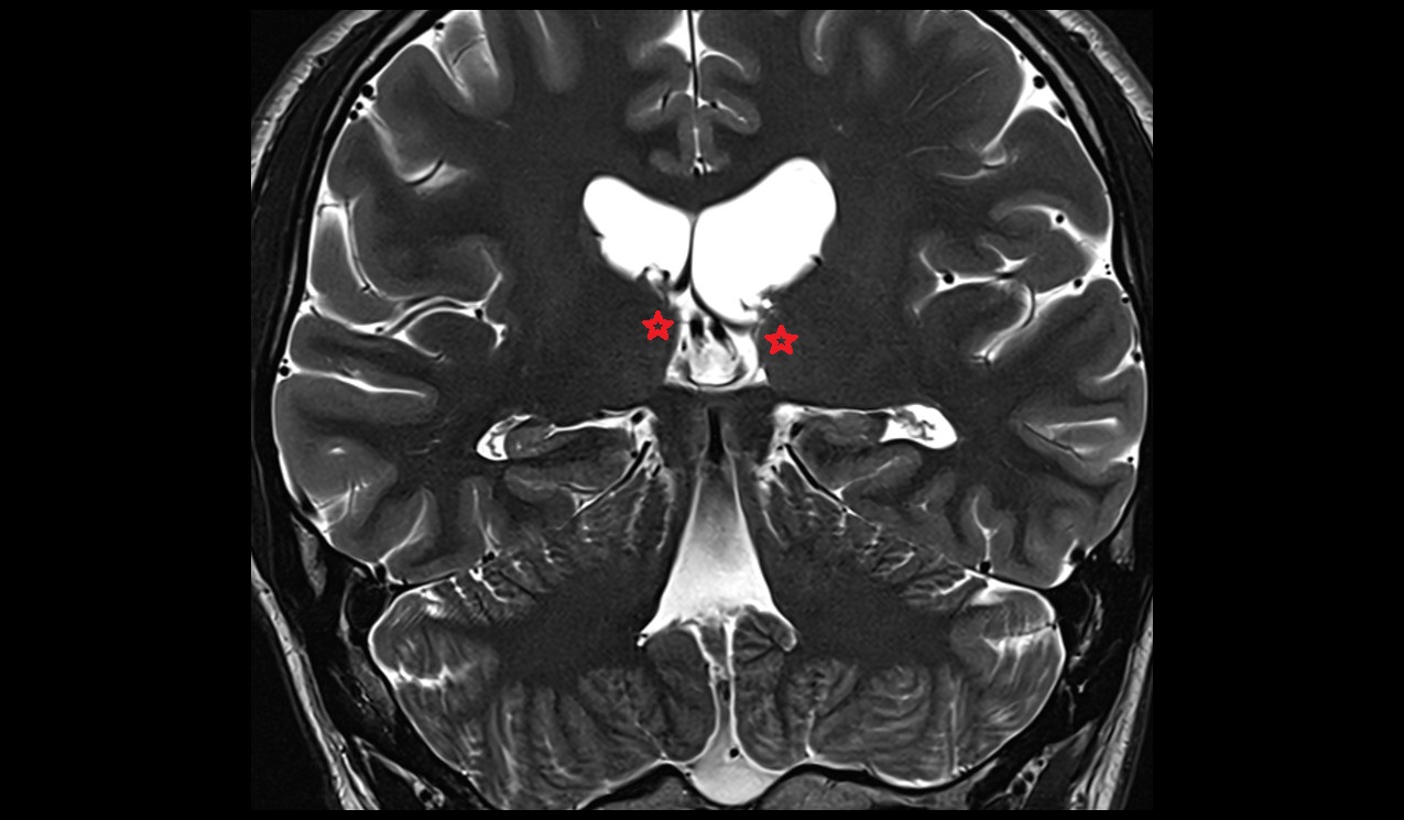 Pulvinar mri 3t coronal image