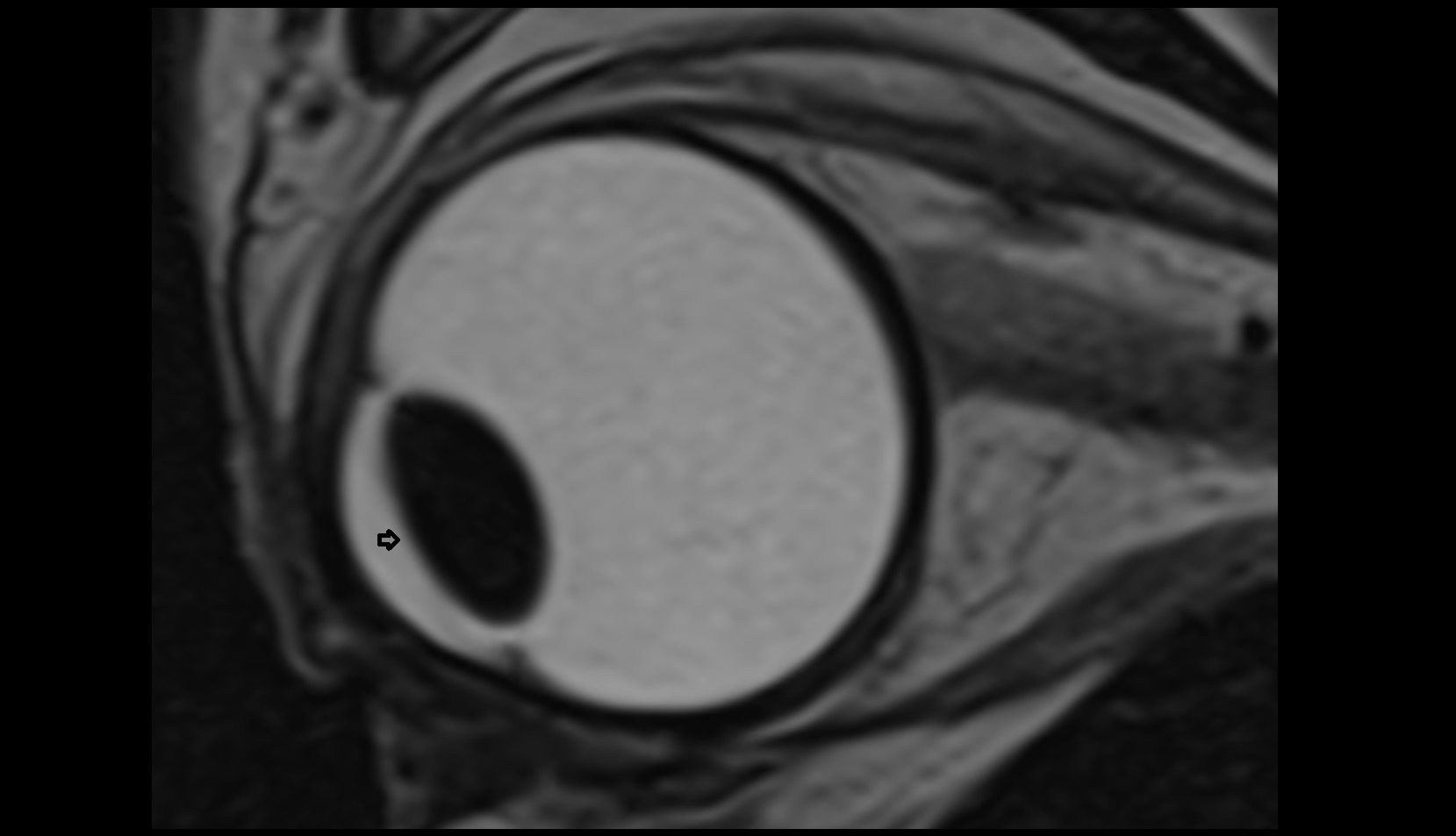 Pupil mri image