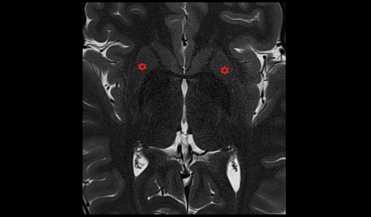 Putamen mri 3t  axial image
