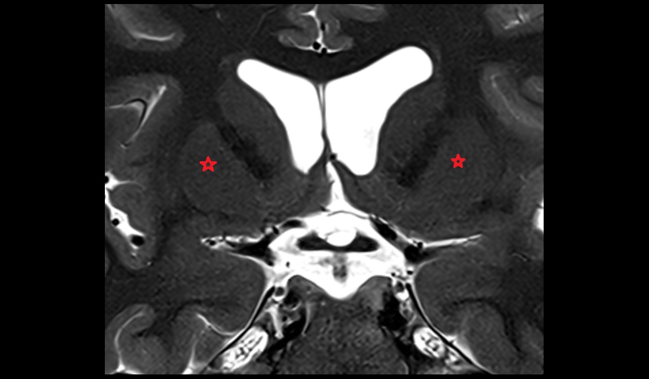 Putamen mri 3t coronal image