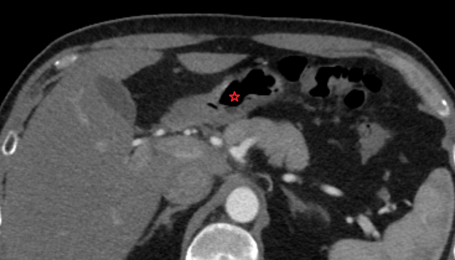 Pyloric canal  anatomy  CT axial  image -img-00000-00000