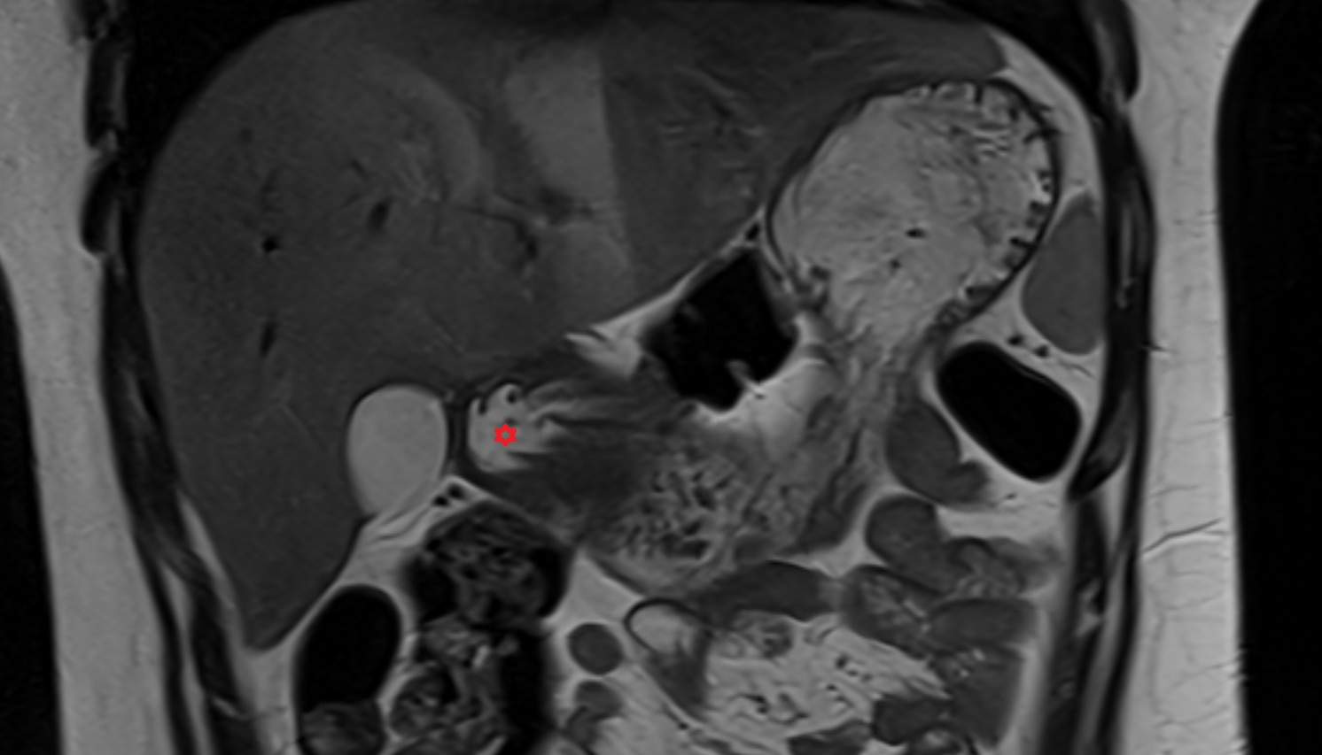 Pyloric canal  anatomy  MRI CORONAL  image -img-00000-00000