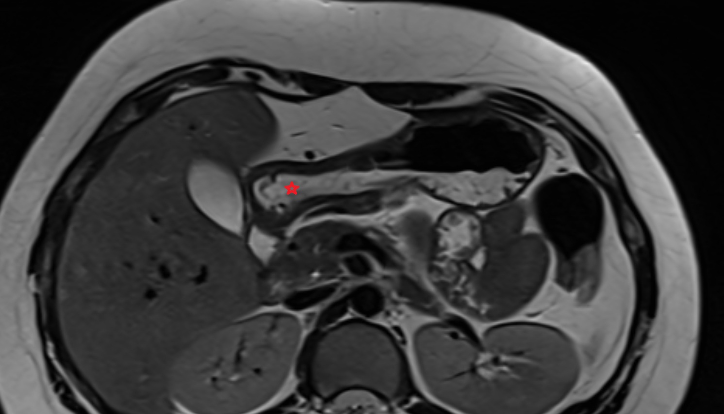Pyloric canal  anatomy  MRI axial  image -img-00000-00000