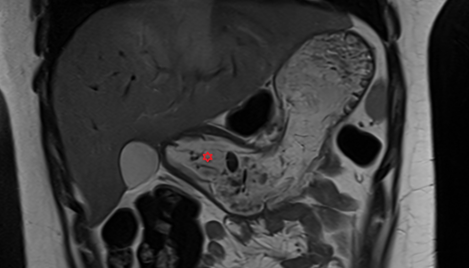Pylorus of stomach  anatomy  MRI CORONAL  image -img-00000-00000