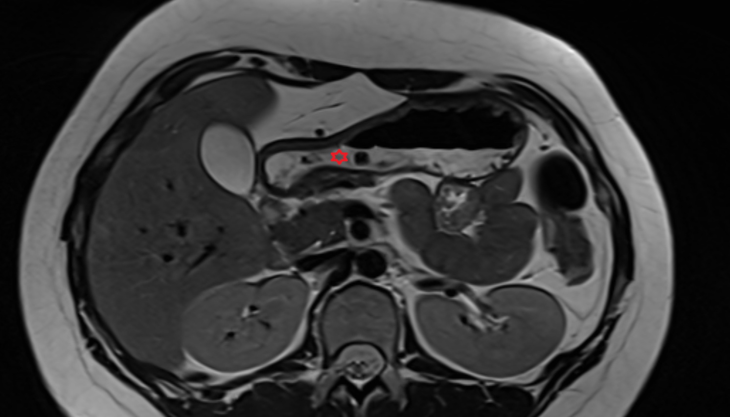 Pylorus of stomach  anatomy  MRI  axial  image -img-00000-00000