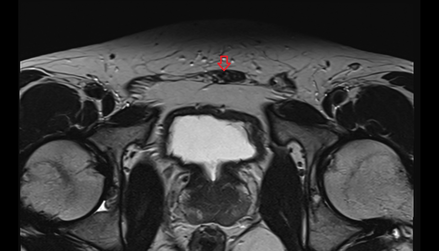 Pyramidal muscle MRI axial  anatomy  image-img-00000-00000