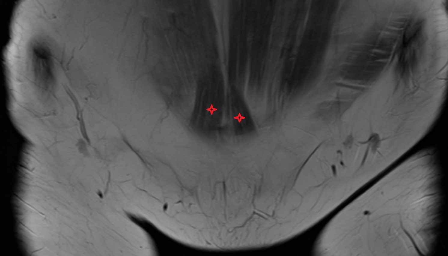 Pyramidal muscle MRI coronal anatomy  image-img-00000-00000