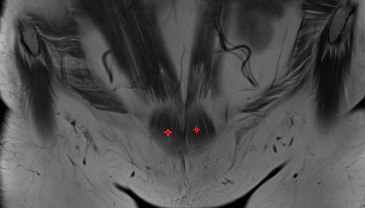 Pyramidal muscle MRI coronal anatomy  image-img-00000-00000_00001