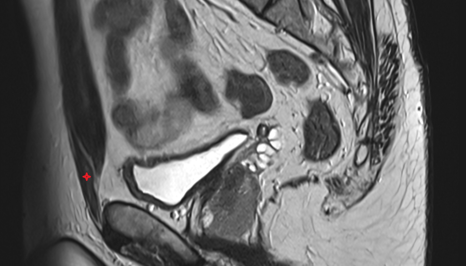 Pyramidal muscle MRI sagittal  anatomy  image-img-00000-00000