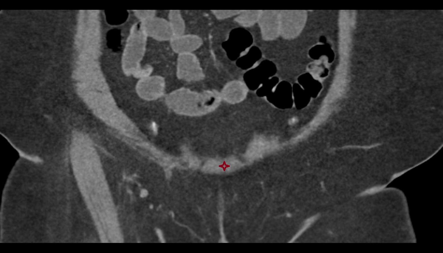 Pyramidal muscle ct coronal  anatomy  image-img-00000-00000