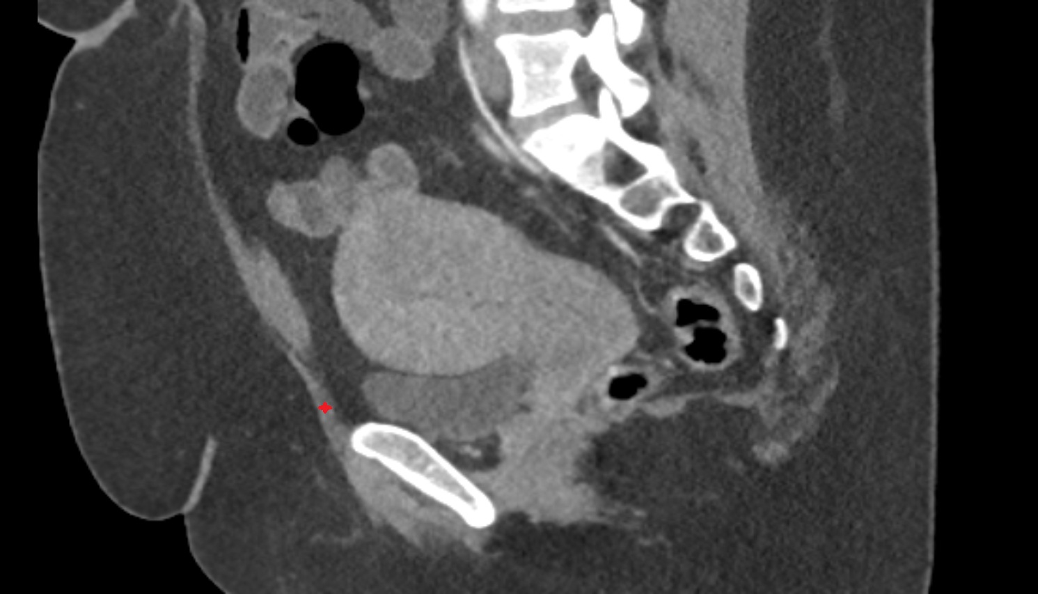 Pyramidal muscle ct sagittal  anatomy  image-img-00000-00000