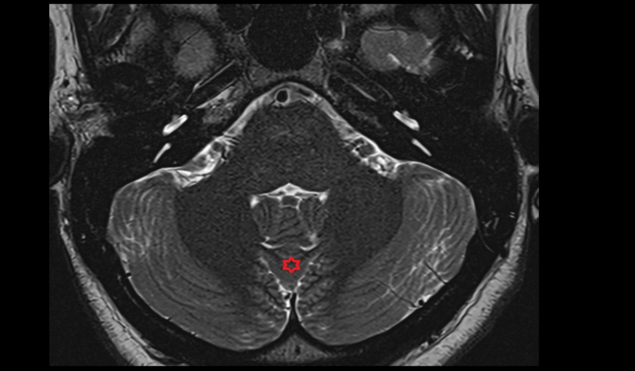 Pyramis of vermis MRI 3T axial image