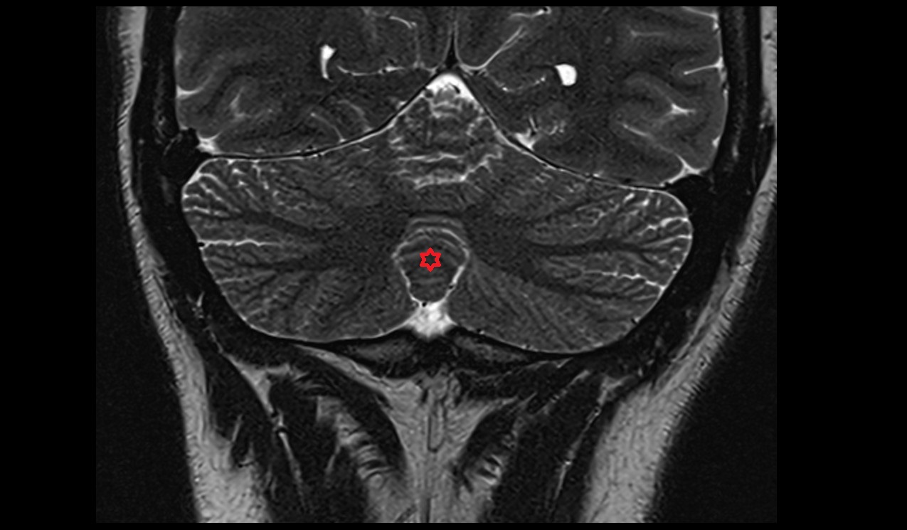 Pyramis of vermis MRI 3T coronal image