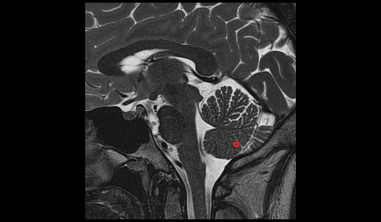 Pyramis of vermis MRI 3T sagittal  image