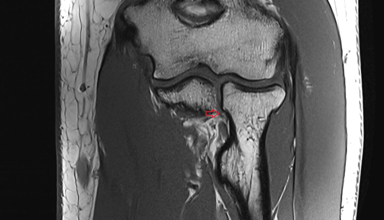 Quadrate ligament (ligament of Denucé) of elbow transverse bundle axial cross sectional anatomy 3T MRI AI enhanced radiology image -img-00000-00000_00001