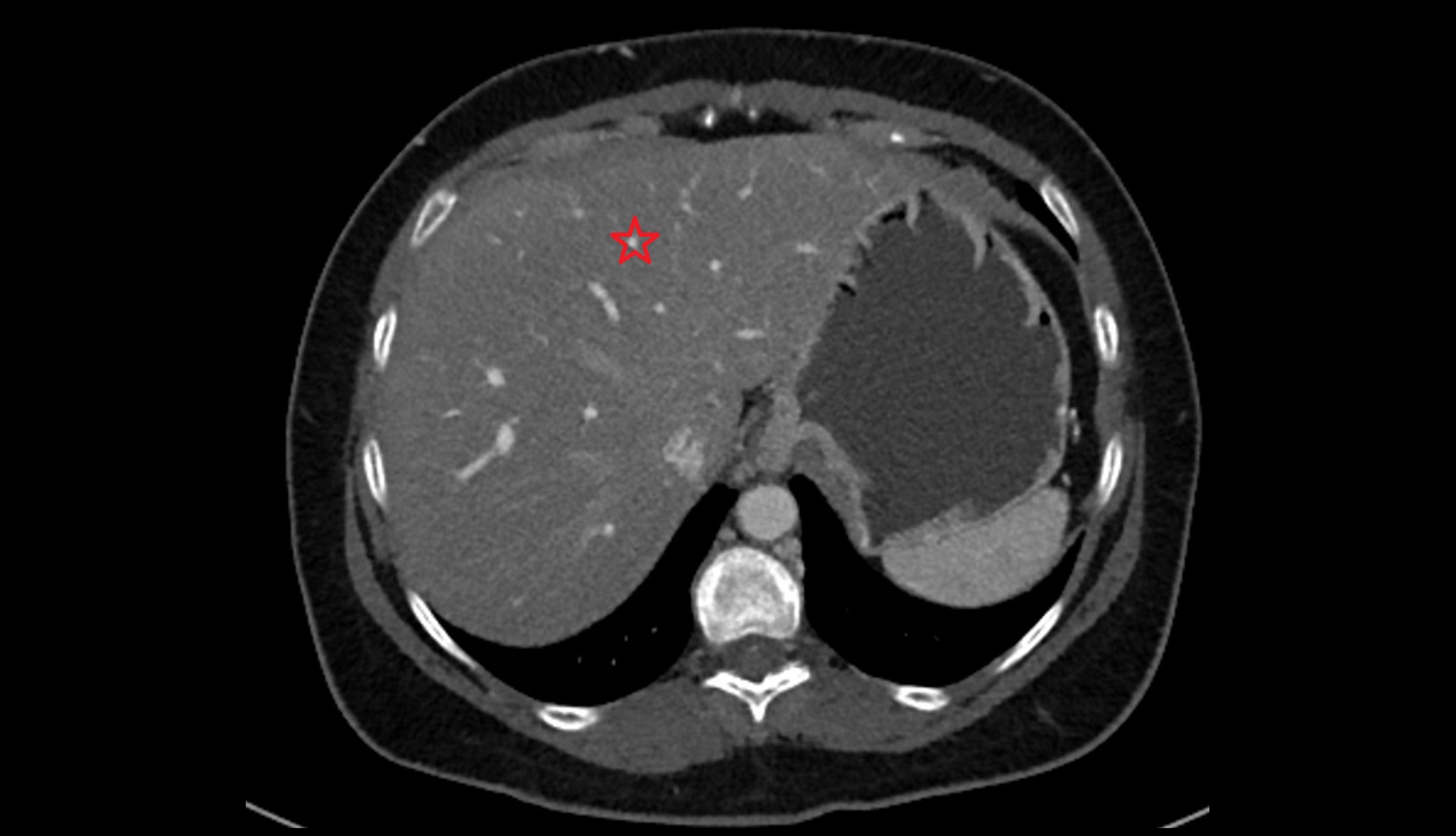 Quadrate lobe of the liver CT axial image