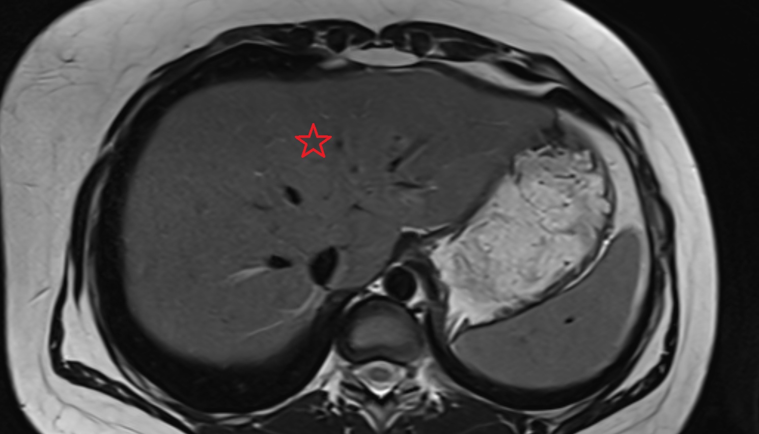 Quadrate lobe of the liver  MRI  axial  anatomy  image-img-00000-00000