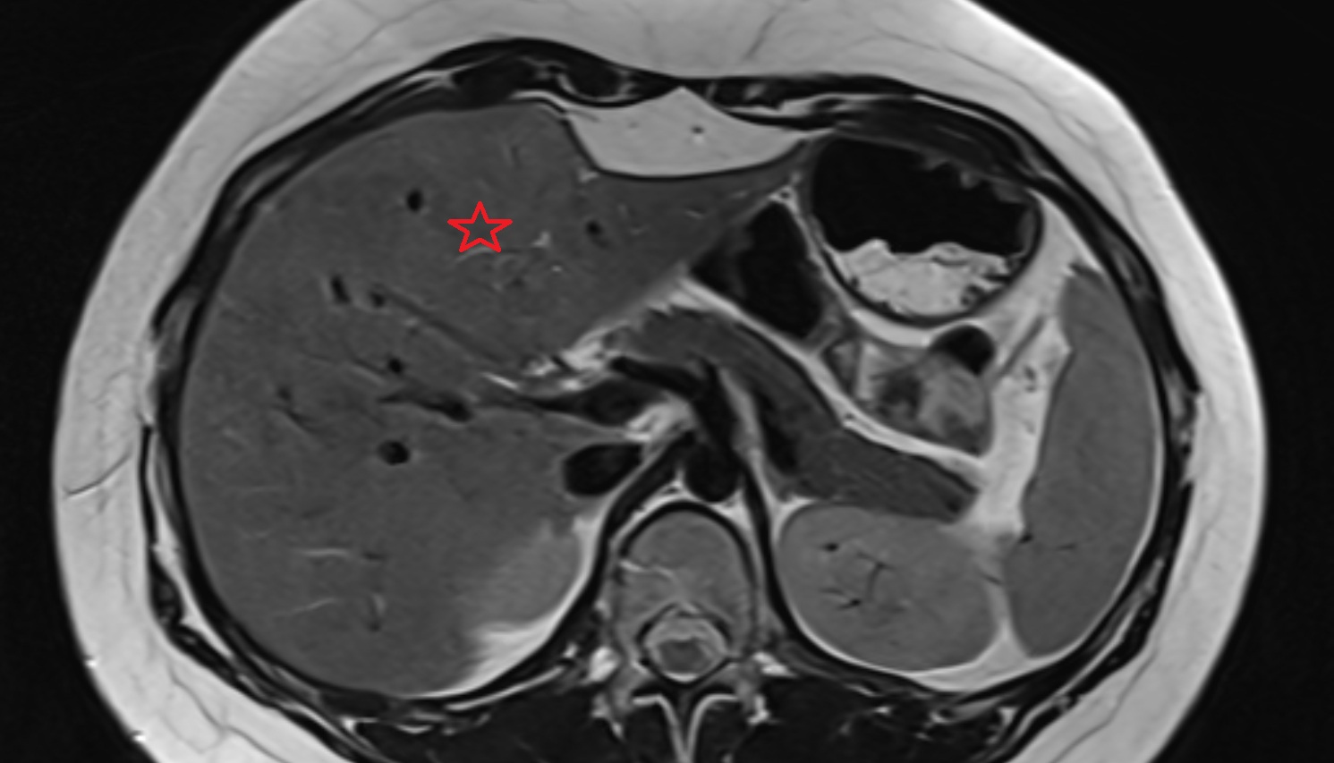 Quadrate lobe of the liver  MRI  axial  anatomy  image-img-00000-00000_00001