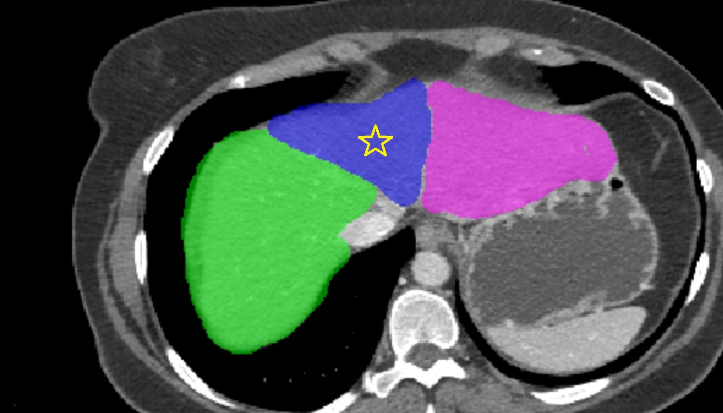 Quadrate lobe of the liver  ct  axial  anatomy  image-img-00000-00000