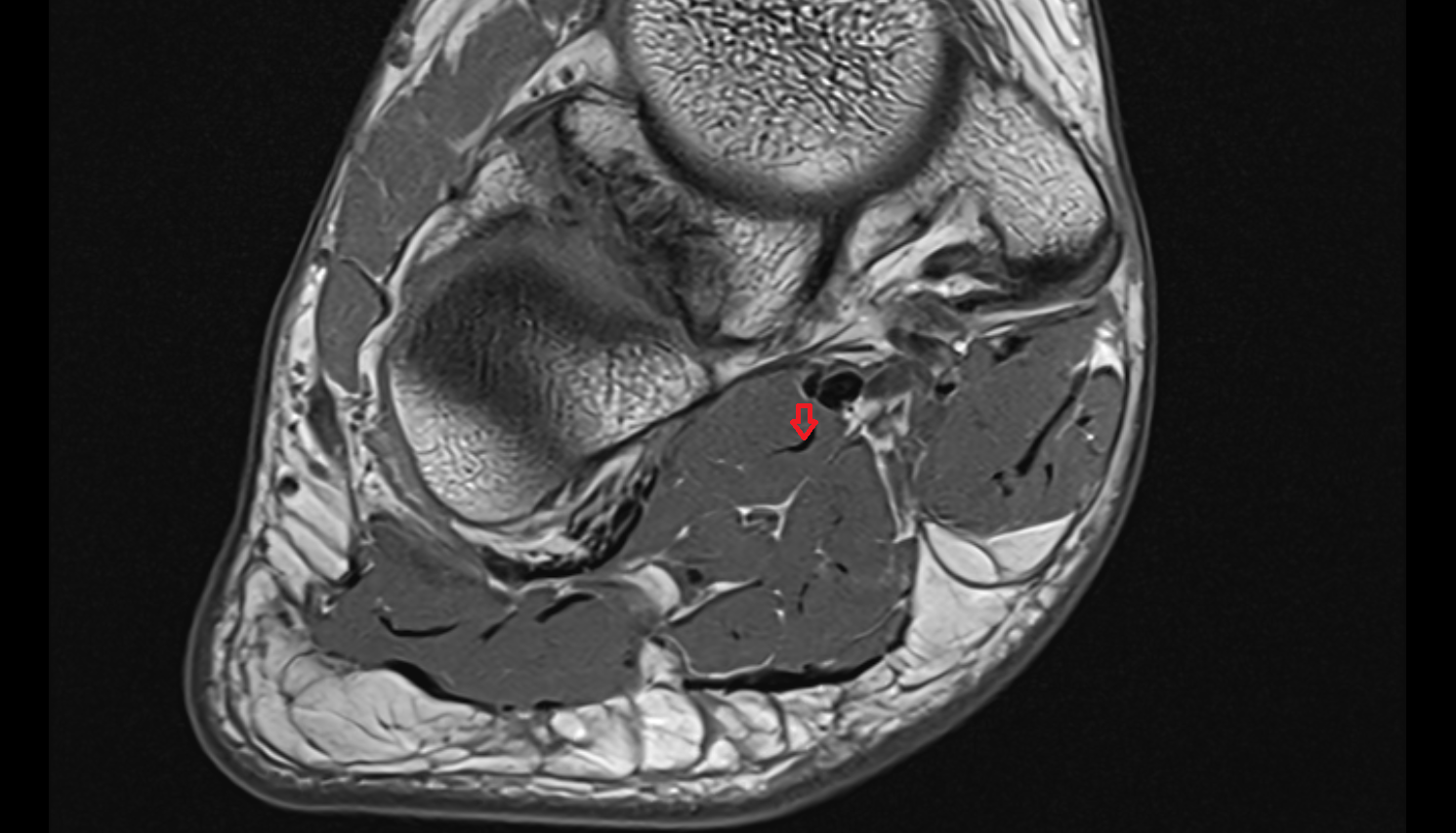 Quadratus Plantae Tendon axial cross sectional anatomy 3T MRI AI enhanced radiology image-img-00000-00000