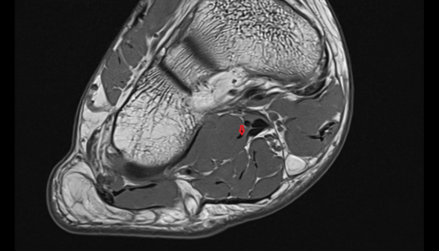 Quadratus Plantae Tendon axial cross sectional anatomy 3T MRI AI enhanced radiology image-img-00000-00000_00001