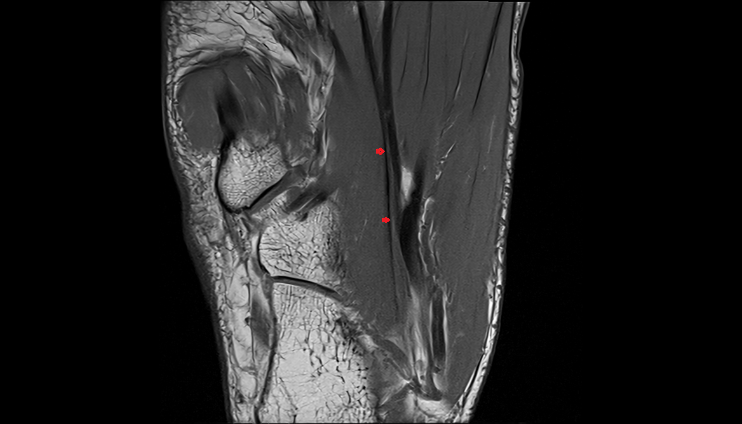 Quadratus Plantae Tendon axial cross sectional anatomy 3T MRI AI enhanced radiology image-img-00000-00000_00002