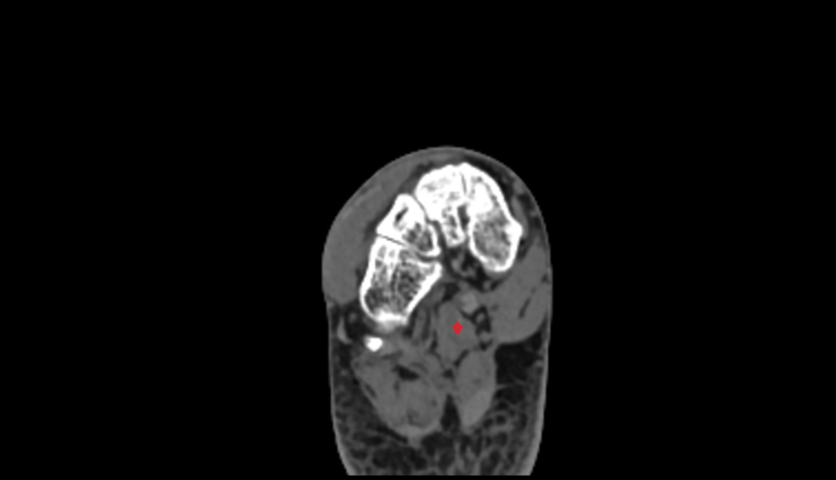 Quadratus Plantae Tendon ct axial image