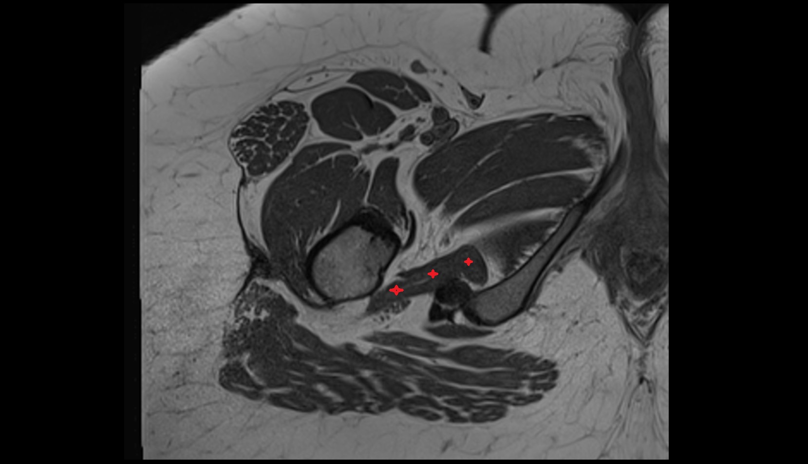 Quadratus femoris muscle  MRI AXIAL IMAGE
