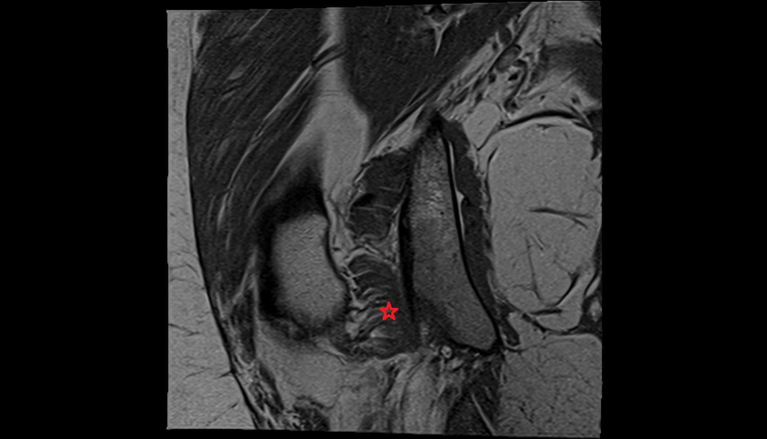 Quadratus femoris muscle  MRI CORONAL  anatomy image-img-00000-00000