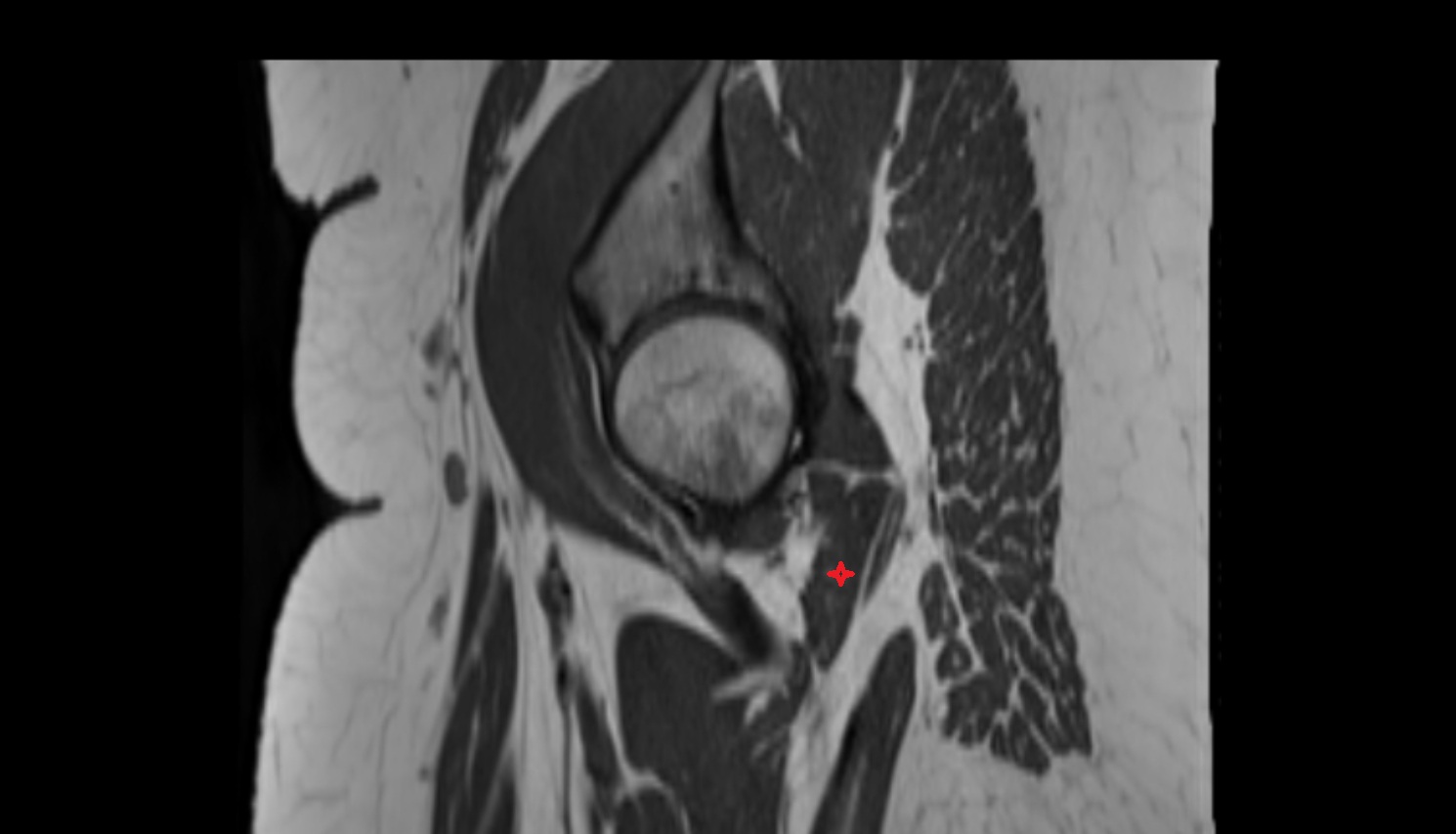 Quadratus femoris muscle  MRI SAG anatomy image-img-00000-00000_00001