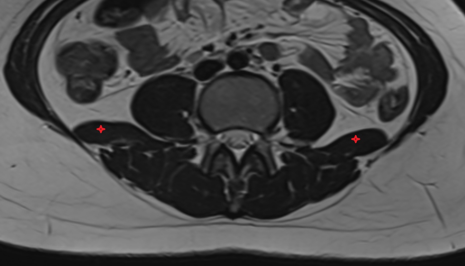 Quadratus lumborum muscle  MRI axial  image anatomy  image -img-00000-00000